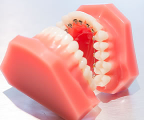 本格的歯科矯正の目的